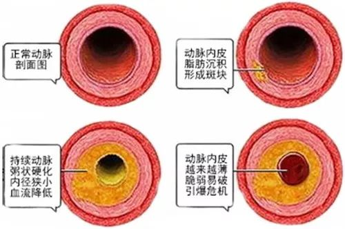 動(dòng)脈硬化.png